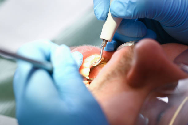 Best Emergency Treatment for Dental Infections or Abscesses in Parkville, MD
